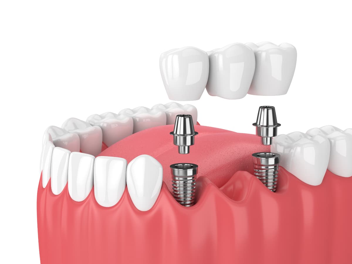 DENTAL IMPLANTS