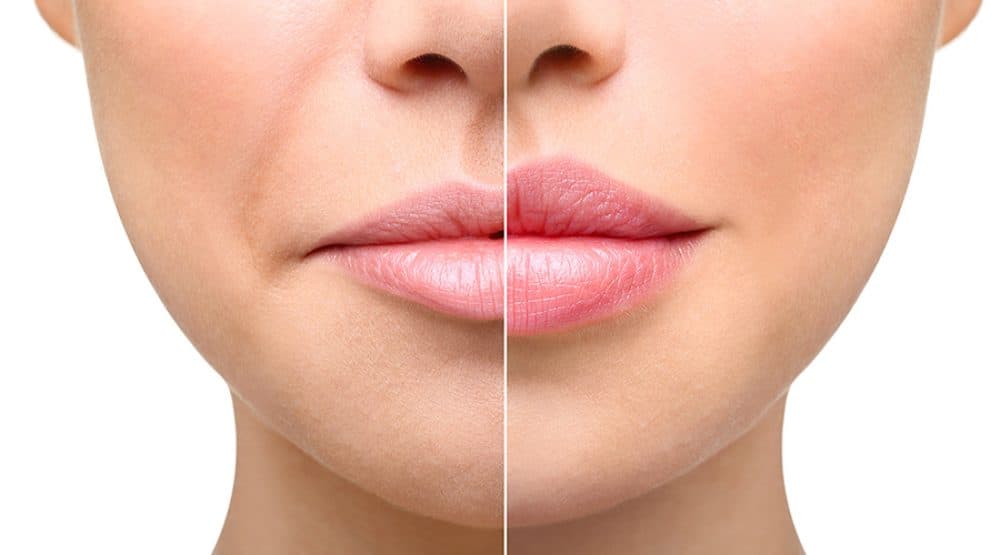 DERMAL FILLERS
