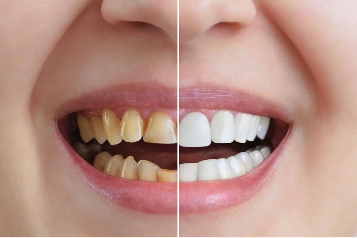PROFESSIONAL WHITENING